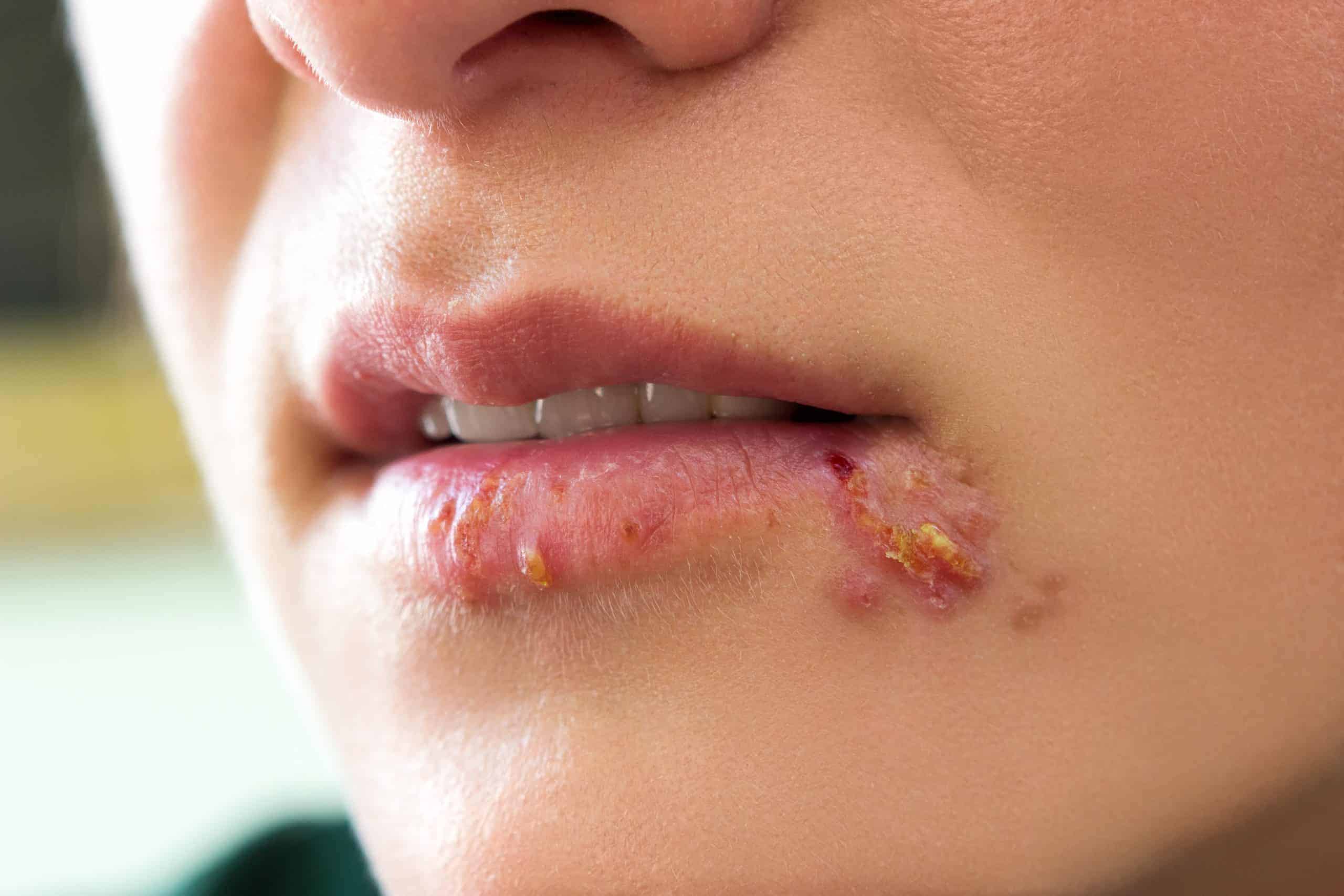 person-with-cold-sores