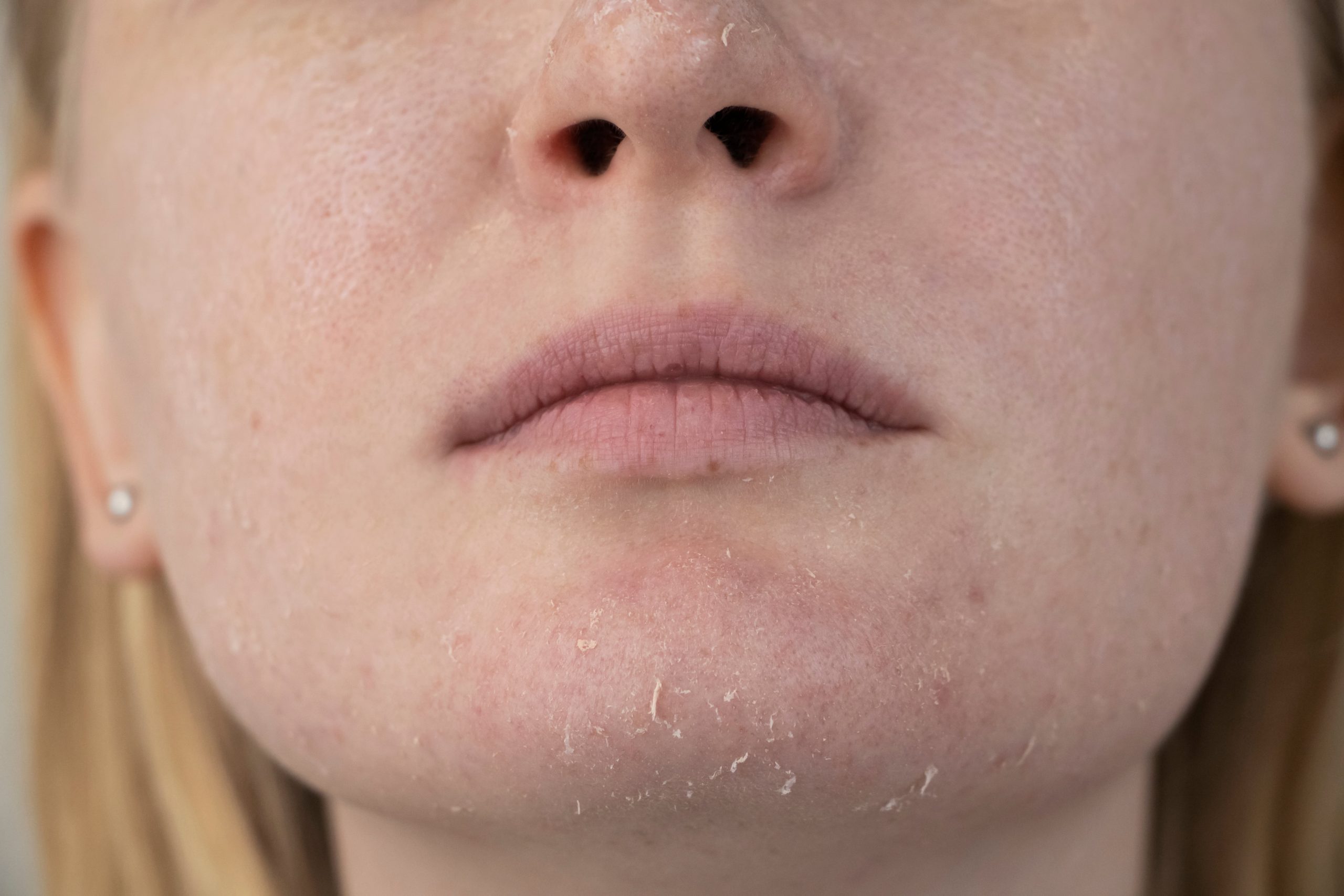 woman-with-dry-skin