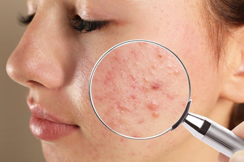 A girl with an acne skin condition