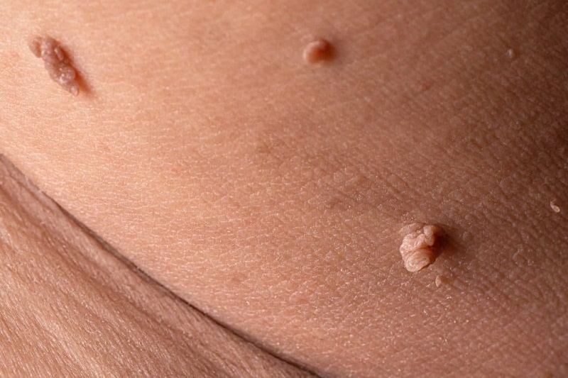 A part of the body that has skin tags